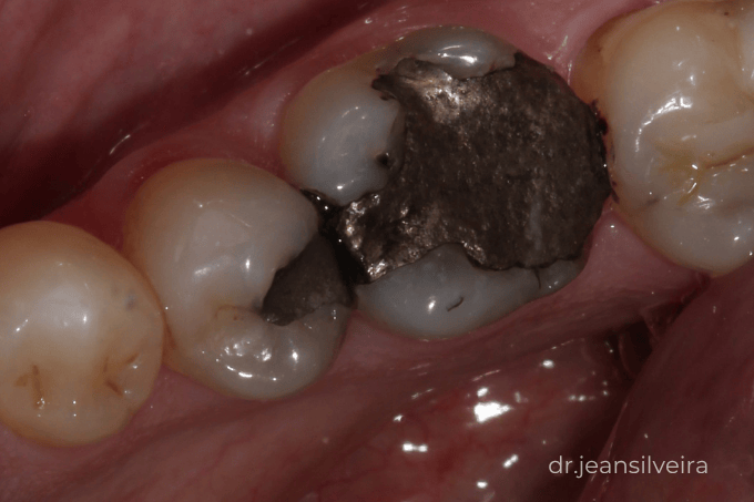 troca de amálgama por resina vale a pena para evitar fratura dentária