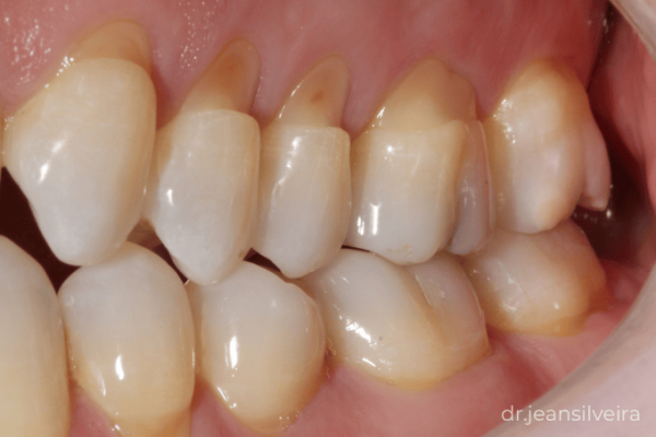 cavidades não cariosas em dente com desgaste próximo à gengiva